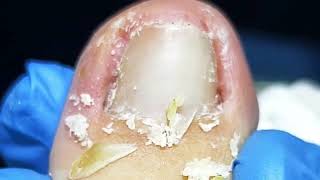 Dig Out Ingrown Toenails and Dead Skin 【Yinuo Pedicure】 [upl. by Notaes]