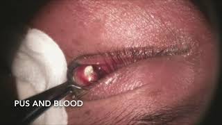 Incision and Drainage of Chalazion [upl. by Iorgos159]