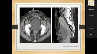 Postpartum obstetric complication Dr Eman Montaser Dr Ffatemazahraa DEnewar [upl. by Ahcsim]