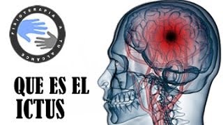 Que es un infarto cerebral ictus o acv por que se produce [upl. by Latricia]