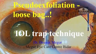 Pseudoexfoliation Loose bag and a hard cataract The IOL Trap Technique Full case Dr Deepak Megur [upl. by Trahern580]