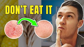 Top 5 Foods to Remove if you Have Psoriasis [upl. by Hecker]