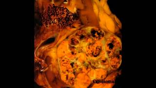 Blasted Pancreas  Carcinoma FULL ALBUM 2011  Pathological Goregrind [upl. by Astto422]