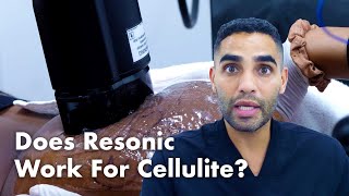 The Newest Treatment for Cellulite Resonic [upl. by Eniala]