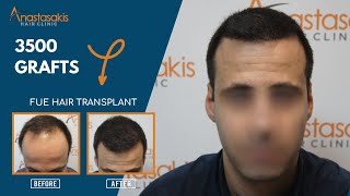 Incredible Transformation FUE amp 3500 grafts  12 months after Hair Transplant 🌟✨ Case 281 [upl. by Dyraj426]