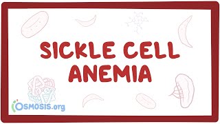 Sickle cell anemia  causes symptoms diagnosis treatment amp pathology [upl. by Ennahs651]