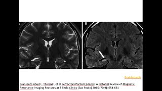 15 Hippocampal sclerosis mesial temporal MTS epilepsy 7T dentate Ammons horn neuroimaging [upl. by Ney332]