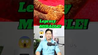 Leprosy Healing MIRACLE 😱 prayer supernatural [upl. by Nylauqcaj341]