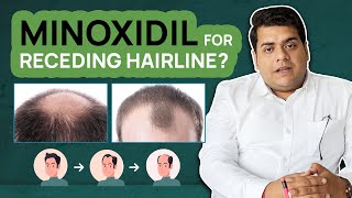 Receding Hairline in Men Expert Tips and Treatments [upl. by Sicard]