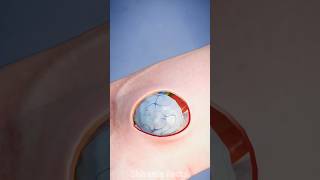 How to fix Ganglion cyst 😲 [upl. by Calabresi310]