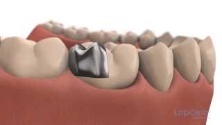 Inlays and onlays  Lapointe dental centres [upl. by Grosz]