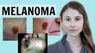 Melanoma skin cancer QampA with dermatologist Dr Dray [upl. by Kreiner]