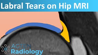 Labral Tears on Hip MRI [upl. by Noivaz885]