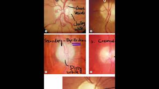 Optic Atrophy  Clinical Appearance of Each Type Shorts [upl. by Aicala194]