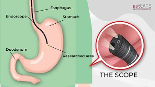 Preparing For Your Gastroscopy OGD  GUTCARE [upl. by Nosyd531]