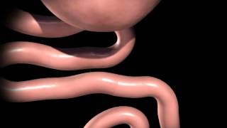 Gastric Bypass Animation [upl. by Parrie]