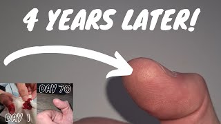 4 Years Later after slicing my finger open [upl. by Cody]