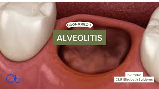 Alveolitis  qué es síntomas y tratamiento [upl. by Annauqaj]