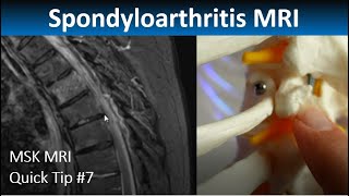 MRI in Axial Spondylarthritis Thoracic Spine Inflammation MSK MRI Quick Tip [upl. by Mita]