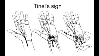 Tinels Sign Clinical Test Definition Procedure Meaning Positive Negative Associated condition [upl. by Hisbe843]