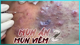 Big Cystic Acne Blackheads Extraction Blackheads amp Milia Whiteheads Removal Pimple Popping [upl. by Sargent]