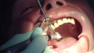 Removing sutures and porcelain teeth  temporary teeth Part 1 of 2 [upl. by Jahdiel]