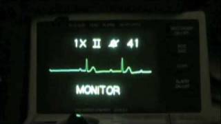 Vital Ethics ACLS ECG Recognition Sacramento [upl. by Danica398]