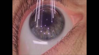 Cirugía Refractiva Lasik con Láser Excimer  Clínica Coro [upl. by Nyladnohr]