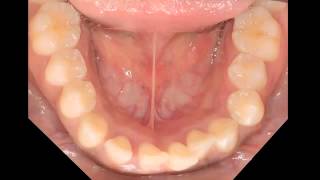 Aggressive periodontitis [upl. by Adnaugal]