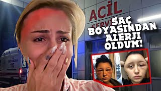 EN CİDDİ ALERJİLERDEN BİRİ KAFAM ŞİŞTİ SAÇ BOYASI [upl. by Ttehr]