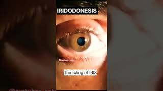 IRIDODONESIS Trembling of IRIS eyetuberoptomeyehealtheyecareshorts [upl. by Sigsmond]