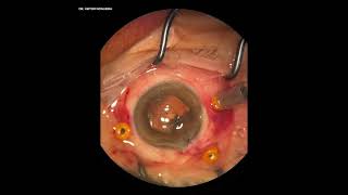 Phaco  PPV  ILM Peeling  SF6  Macular Hole [upl. by Brebner]