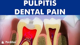 Pulpitis  Inflammation of tooth pulp © [upl. by Ahsahs315]