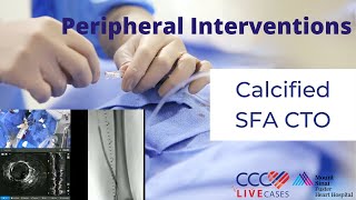 CCC Live Cases  Peripheral Interventions  Calcific SFA CTO  January 24 2024 [upl. by Theressa]