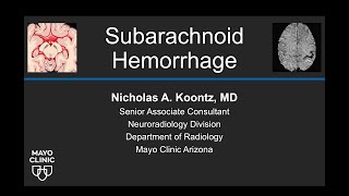 Subarachnoid Hemorrhage [upl. by Eidnarb]