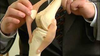 QuadricepsSparing Knee Replacement  UW Medicine [upl. by Dewhurst]