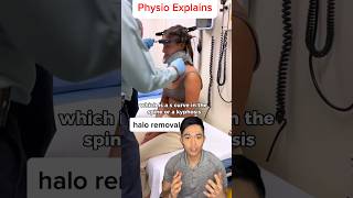 Halo Brace Removal for Scoliosis halo physicaltherapist posture scoliosistreatment [upl. by Eylsel]