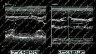 Segmentation de la valve mitrale sur cardiopixelcom [upl. by Enyleuqcaj]