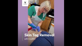 Skin Tag Removal with CryoPen at DRVICTORIA™ Clinic in Edinburgh [upl. by Tsuda27]