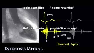 Auscultación de la Estenosis Mitral [upl. by Spurgeon955]