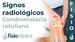 Condromalacia rotuliana Signos radiológicos  FisioClinics Palma de Mallorca [upl. by Nalon139]