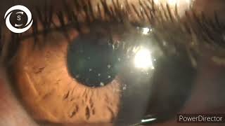 Adenoviral punctate keratitis [upl. by Nylssej]