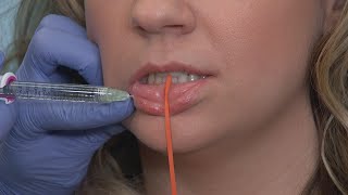 Keyhole Pout Procedure for Fuller Lips [upl. by Pembrook]