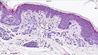 Compound Melanocytic Nevus  Histopathology [upl. by Normi]