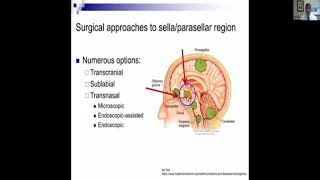 Pituitary Tumors What You Need to Know about Surgery Webinar [upl. by Seth166]