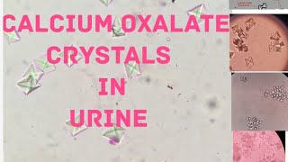 Calcium oxalate crystals in urine [upl. by Nishi]