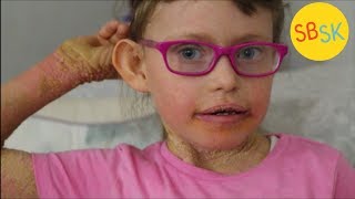 Living With Scaly Skin Ichthyosis [upl. by Ydieh]