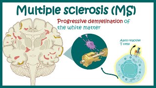 Multiple sclerosis  Types of Multiple Sclerosis  Causes symptoms diagnosis treatment pathology [upl. by Eelibuj]