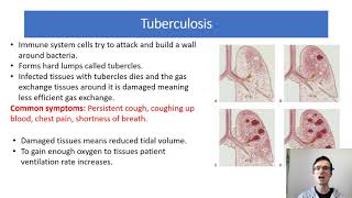 A Level Biology 33 Lung Diseases and Data [upl. by Lucia]