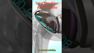 Total shoulder arthroplasty  Principle Procedure and Results [upl. by Shalne304]